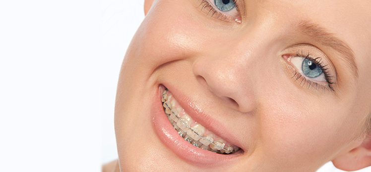 Ceramic Braces For Adults 107