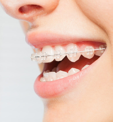 Tooth-Coloured Braces