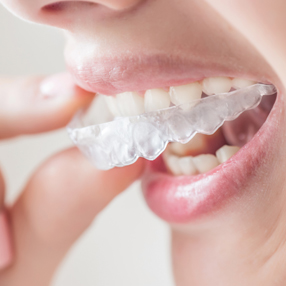 invisalign