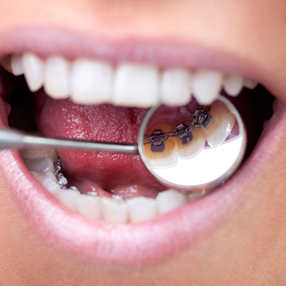 Lingual Braces
