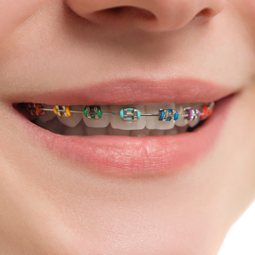 Metal Braces