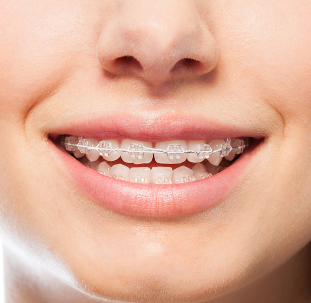 What are ceramic braces?