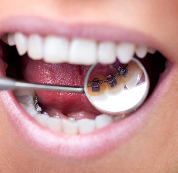 What are lingual braces?