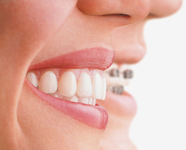 What is Invisalign?