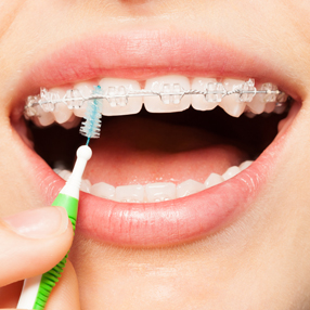 Brace Tips